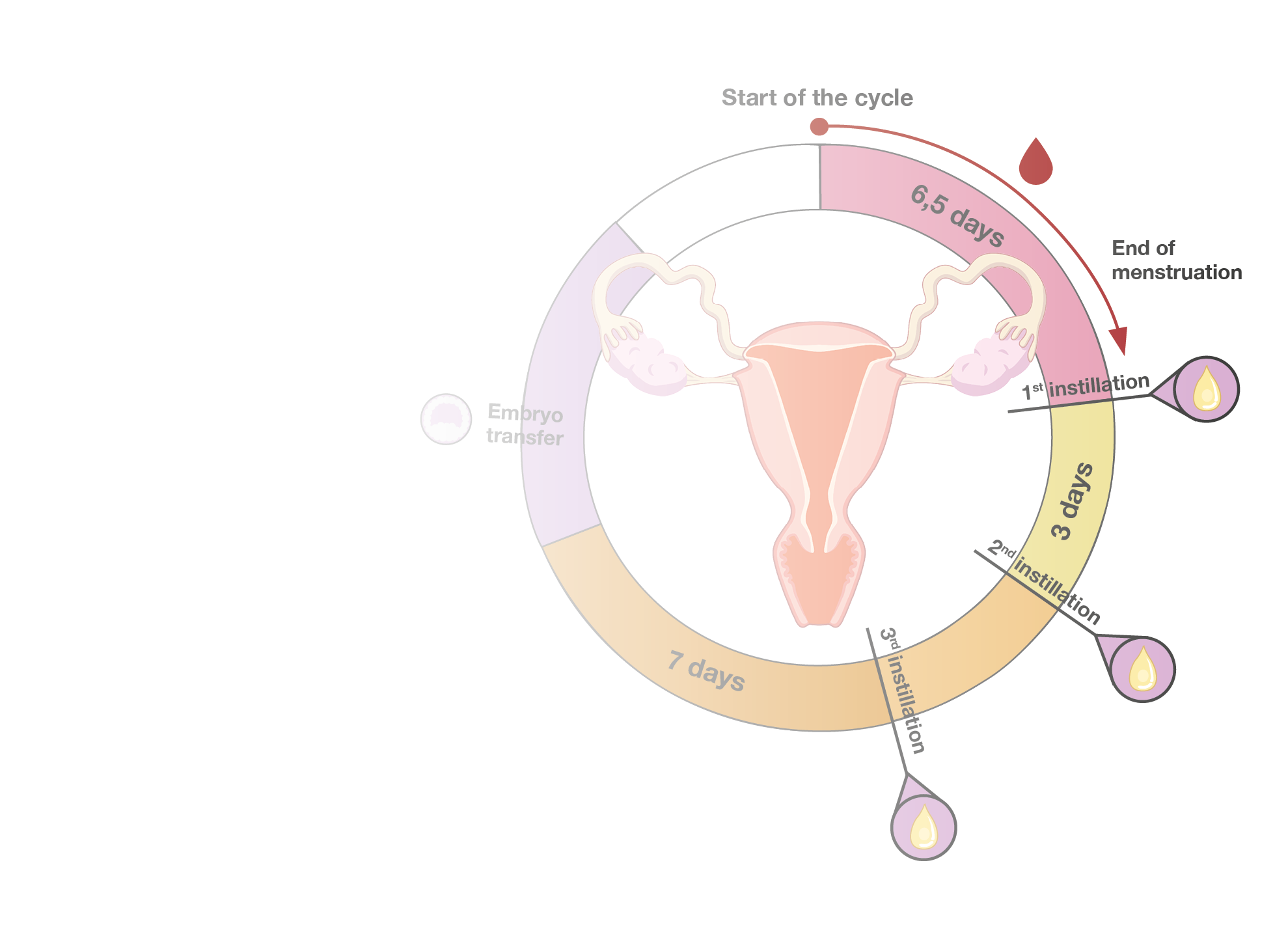 Potential of Plasma Rich in Growth Factors (PRGF-Endoret) to Enhance the Efficacy of Assisted Reproductive Techniques in Refractory Cases.