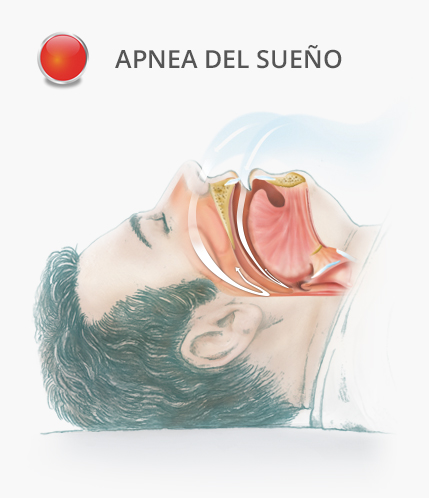 dibujo de hombre con apnea del sueño