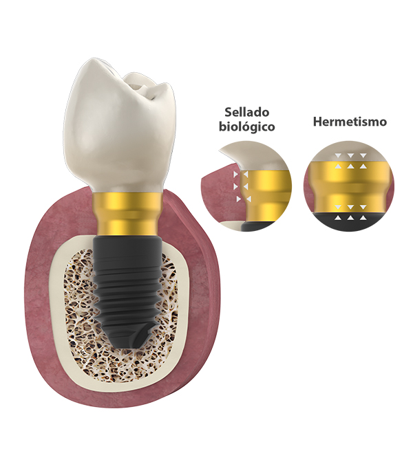 detalle de protesis dental bioblock bti