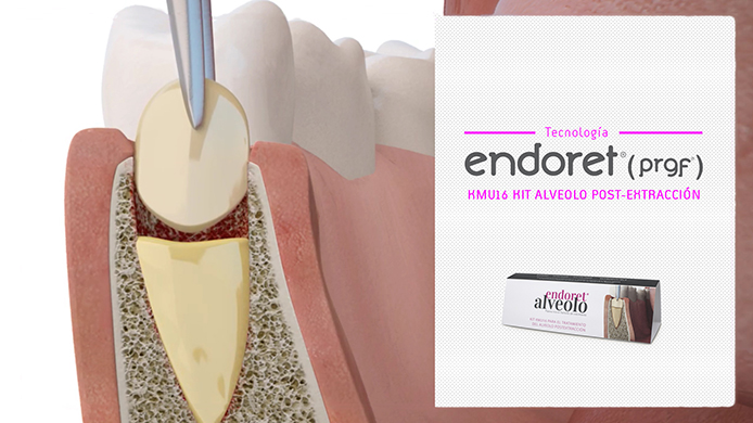 Endoret Kit Alveolo